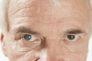 Picture of a senile cataract eye