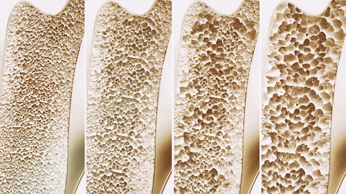 Bone Density Examples